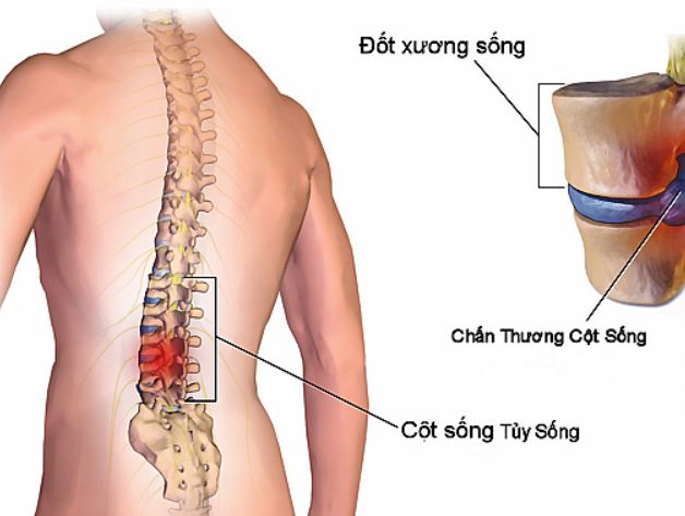Ảnh 1 của Acute Spinal Cord Injury